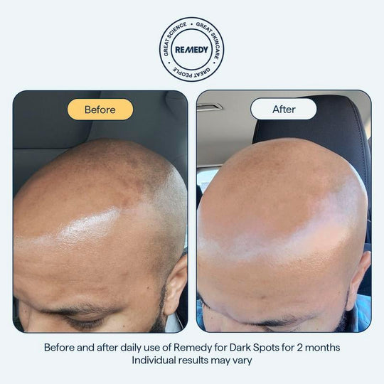 😴😴The REMEDY Overnight Serum: Your Powerhouse in the Fight Against Dark Spots