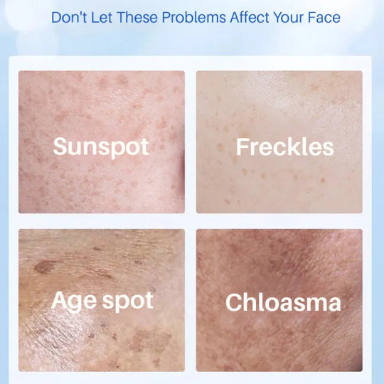 Age Spot Essence Milk Improve Skin Pigmentation Yello Essence Cream for Age Spot Reduction