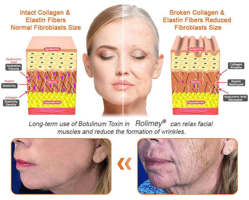 🧑‍⚕️𝑶𝒇𝒇𝒊𝒄𝒊𝒂𝒍 𝑺𝒕𝒐𝒓𝒆 | 𝐑𝐨𝐥𝐢𝐦𝐞𝐲® 𝐁𝐨𝐭𝐨𝐱 𝐁𝐞𝐞 𝐕𝐞𝐧𝐨𝐦 𝐅𝐢𝐫𝐦𝐢𝐧𝐠 𝐒𝐞𝐫𝐮𝐦 𝐒𝐭𝐢𝐜𝐤 - 𝐓𝐚𝐫𝐠𝐞𝐭𝐬 𝐒𝐚𝐠𝐠𝐢𝐧𝐠 𝐒𝐤𝐢𝐧 & 𝐖𝐫𝐢𝐧𝐤𝐥𝐞𝐬 𝐀𝐥𝐥 𝐎𝐯𝐞𝐫 𝐁𝐨𝐝𝐲 𝐰𝐢𝐭𝐡 𝐀𝐝𝐯𝐚𝐧𝐜𝐞𝐝 𝐏𝐞𝐩𝐭𝐢𝐝𝐞 𝐓𝐞𝐜𝐡𝐧𝐨𝐥𝐨𝐠𝐲, 𝐕𝐢𝐬𝐢𝐛𝐥𝐞 𝐑𝐞𝐬𝐮𝐥𝐭𝐬 𝐢𝐧 𝟑 𝐃𝐚𝐲𝐬 (⏳𝐋𝐀𝐒𝐓 𝐃𝐀𝐘 3𝟎% 𝐎𝐅𝐅)