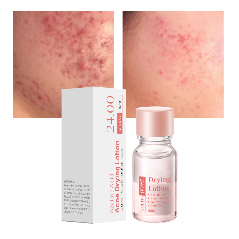 🎉Salicylic Acid Spot Drying Lotion✨