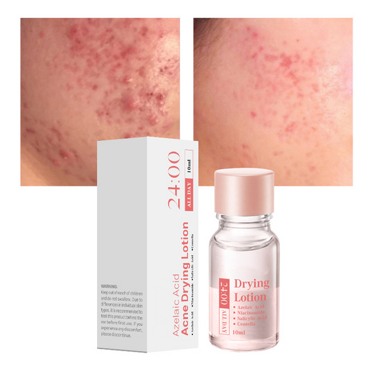 🎉Salicylic Acid Spot Drying Lotion✨