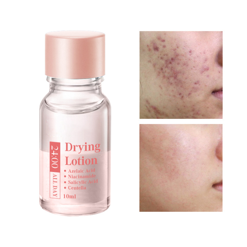 🎉Salicylic Acid Spot Drying Lotion✨